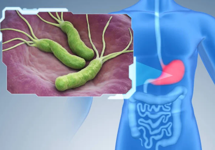 جرثومة المعدة (H. pylori)