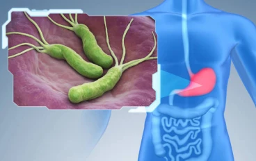 جرثومة المعدة (H. pylori)