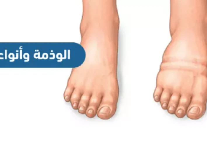 التورم الصامت ( الوذمه )
