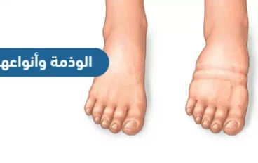 التورم الصامت ( الوذمه )
