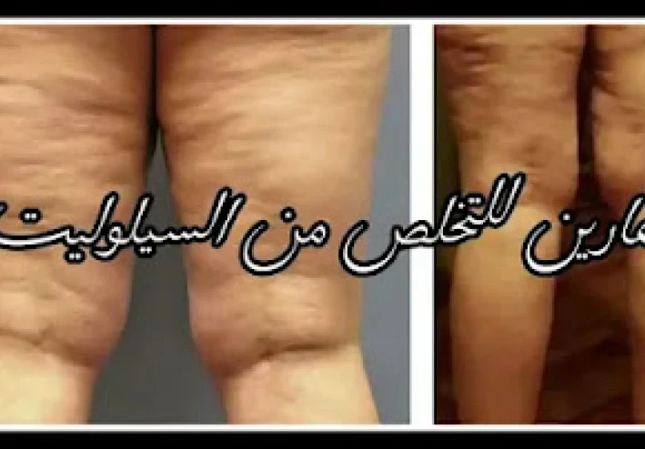 أفضل طريقة لعلاج السيلوليت الجلدي