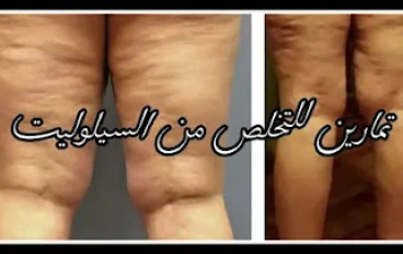 أفضل طريقة لعلاج السيلوليت الجلدي