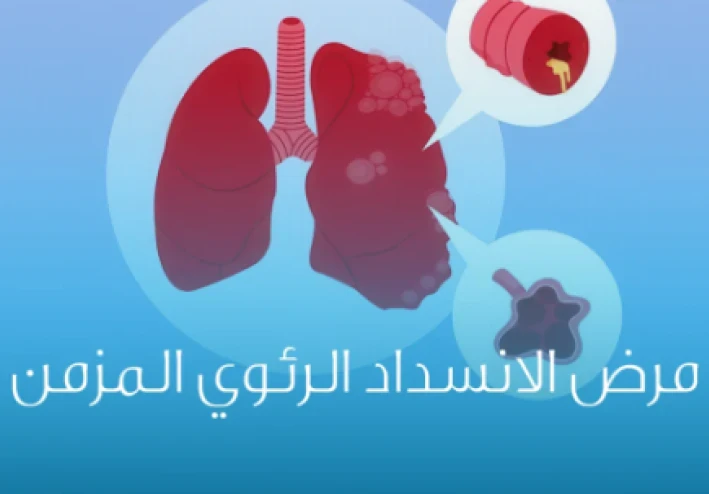 الانسداد الرئوي المزمن