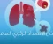 article image for الانسداد الرئوي المزمن