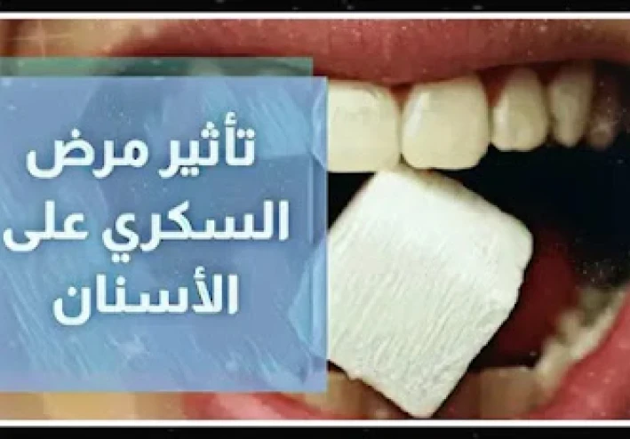 هل مرض السكري يفسد الأسنان؟