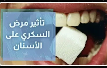 هل مرض السكري يفسد الأسنان؟
