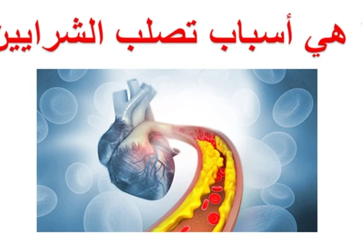 تصلب الشرايين لدى مرضى السكري: أعراض، وأسباب، وعلاج