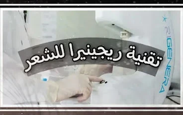 ريجينيرا الشعر زرع الشعر المجهري - Regenera Activa