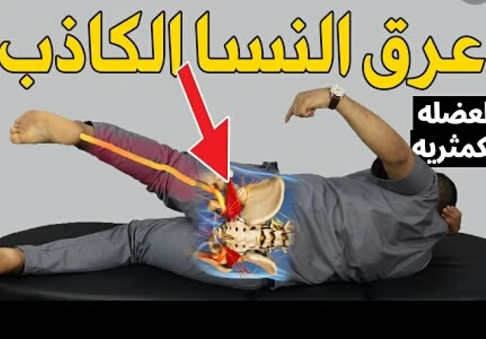 عرق النسا الكاذب