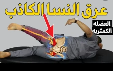 عرق النسا الكاذب