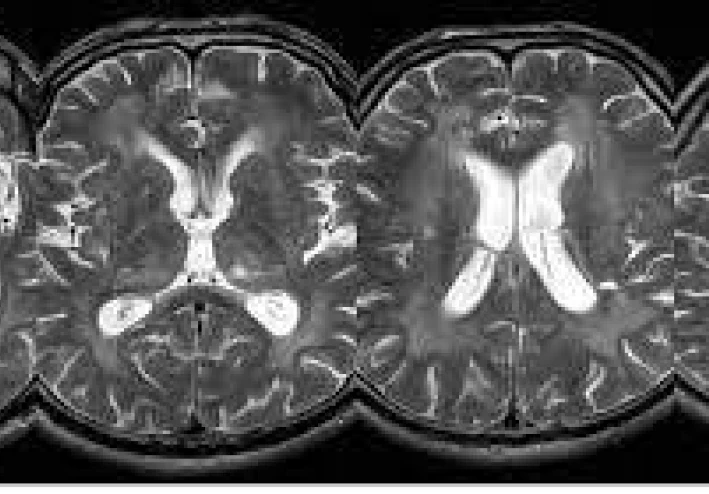 ضمور المادة البيضاء في الدماغ