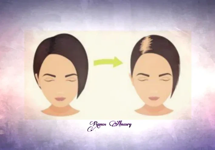 الصلع الوراثي عند النساء