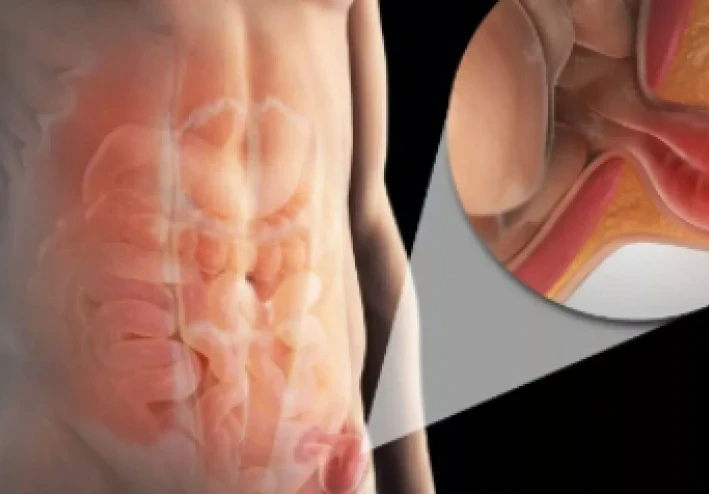 أنواع الفتق الشائعه