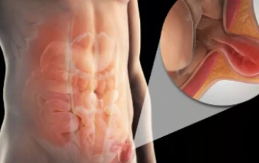 أنواع الفتق الشائعه