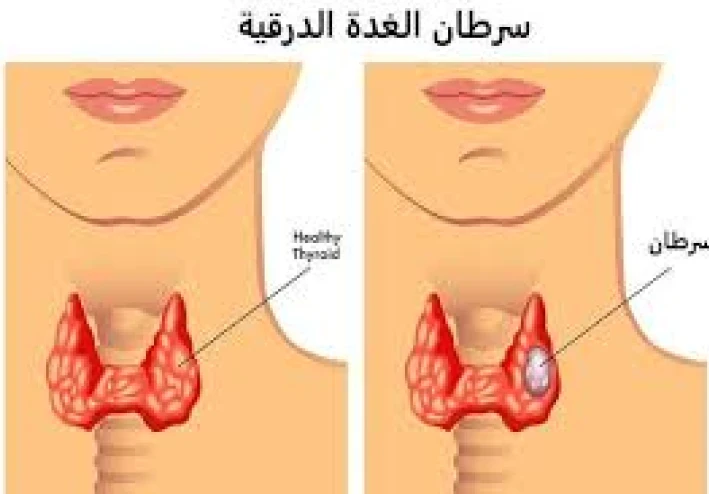 هل سرطان الغدة الدرقية مميت؟ تعرف على أعراض الغدة الدرقية!