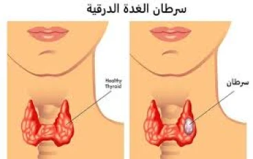هل سرطان الغدة الدرقية مميت؟ تعرف على أعراض الغدة الدرقية!