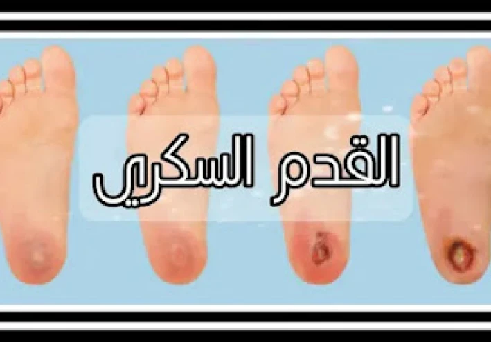 أعراض القدم السكرية وعلاجها
