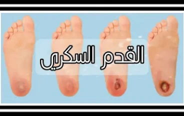 أعراض القدم السكرية وعلاجها