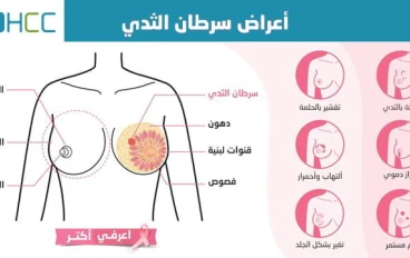 ما هي أعراض مرض سرطان الثدي؟