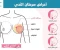 صورة مقال ما هي أعراض مرض سرطان الثدي؟