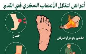 ما هو الاعتلال العصبي السكري؟ تلف الأعصاب الذي يجب أن نأخذه على محمل الجد