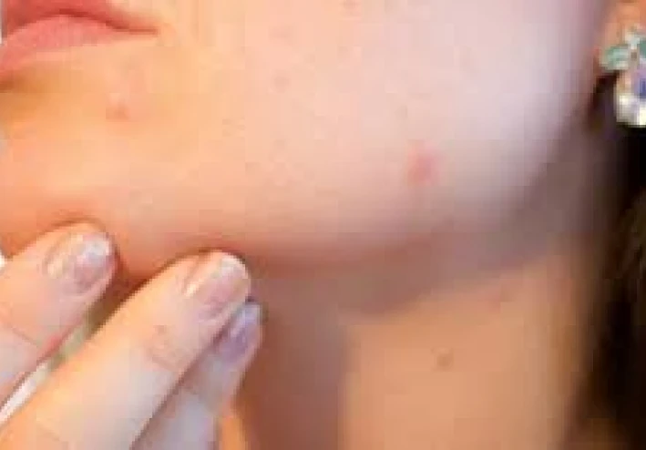 علاج حب الشباب عند البنات بطرق طبيعية فعالة | أسرار البشرة النقية بدون أدوية