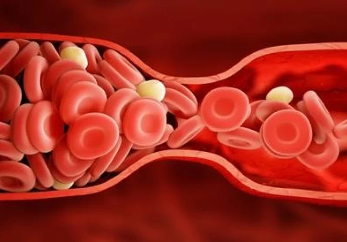الشعور بهذا الألم يشير إلى إصابتك بجلطة دموية خطيرة