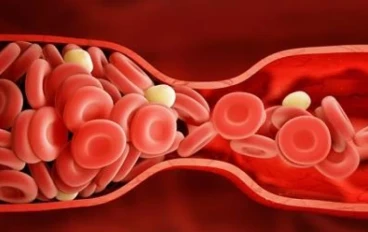 الشعور بهذا الألم يشير إلى إصابتك بجلطة دموية خطيرة