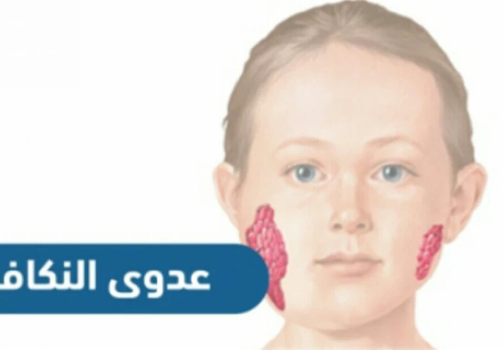 التورم المؤلم للغده اللعابيه