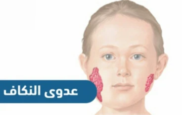 التورم المؤلم للغده اللعابيه