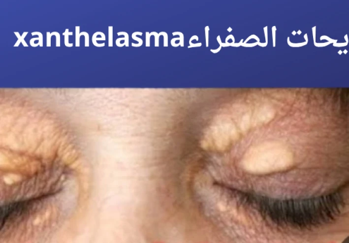 ماهي اللويحات الصفراء وماهي اسبابها وطرق علاجها