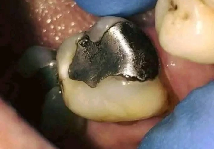 الحشوات المعدنية للأسنان: مميزاتها، أضرارها، ونصائح للحفاظ عليها