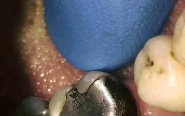 الحشوات المعدنية للأسنان: مميزاتها، أضرارها، ونصائح للحفاظ عليها