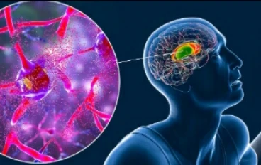 عندما يهاجم الجين المتحور الدماغ.