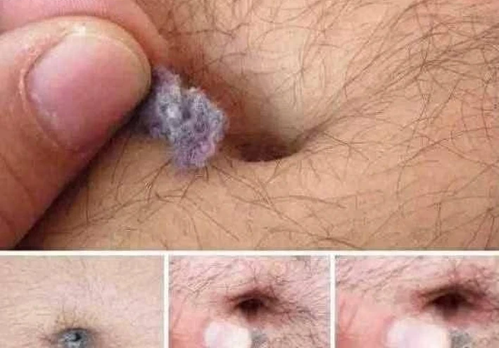 وبر السرة: الأسباب الخفية والعلاقة بالالتهابات والسكري والهرمونات