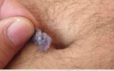 وبر السرة: الأسباب الخفية والعلاقة بالالتهابات والسكري والهرمونات