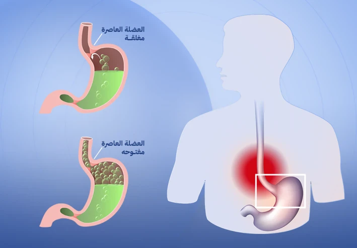ارتجاع المرىء وعلاجه
