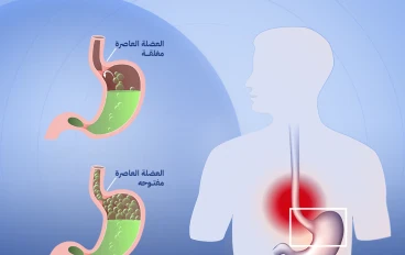 ارتجاع المرىء وعلاجه