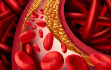 فرط شحميات الدم لدى مرضى السكري: الأسباب، الأعراض والعلاج