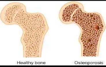 هشاشة العظام: المرض الصامت الذي يهدد قوة الجسم