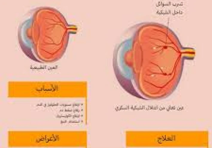 اعتلال الشبكية السكري: الأعراض، والأسباب، والعلاج