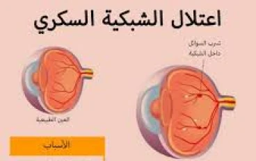 اعتلال الشبكية السكري: الأعراض، والأسباب، والعلاج