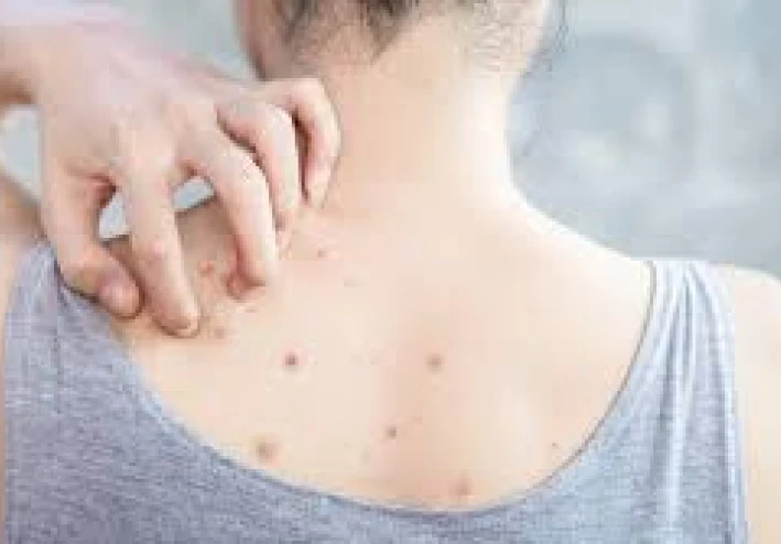 *البثور لدى البنات: الأسباب والعلاج وأفضل طرق العناية بالبشرة للتخلص منها **