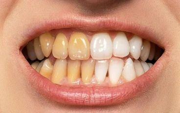 ​✨ طرق تبييض الأسنان الطبيعية: ابتسامة أكثر إشراقاً بخطوات منزلية بسيطة