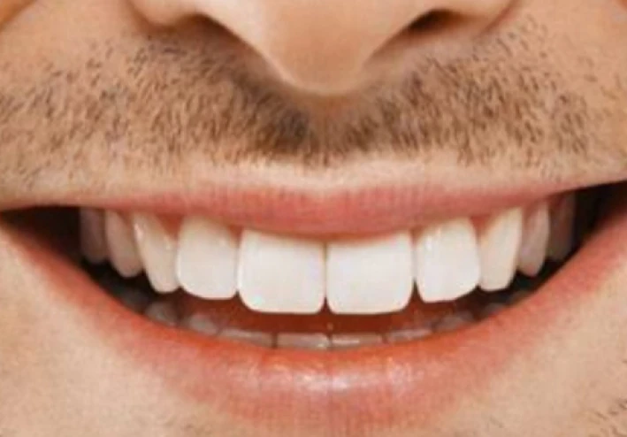 السر الخفي وراء أسنان بلا تسوُّس وما هو اللُّعاب المُدمر