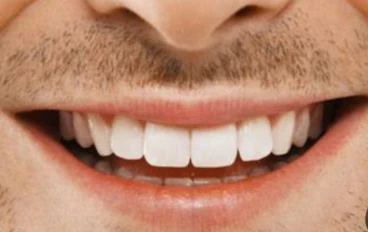 السر الخفي وراء أسنان بلا تسوُّس وما هو اللُّعاب المُدمر