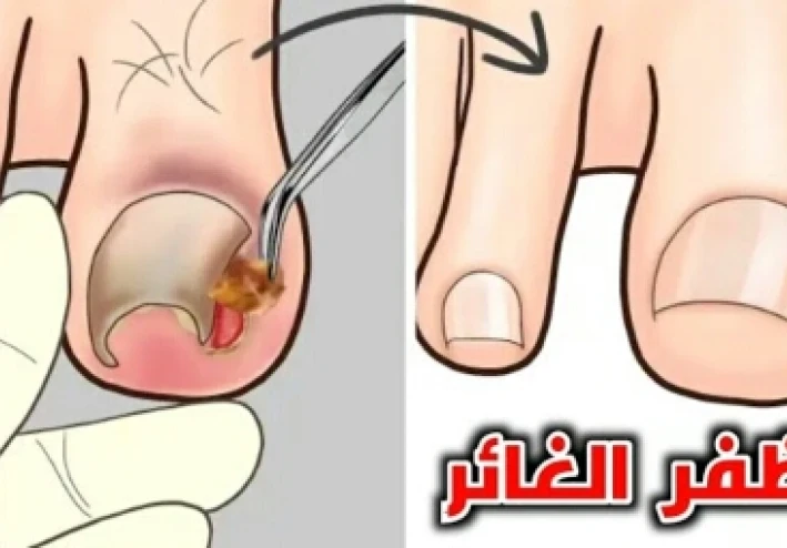 من القص الخاطئ الي العدوى الخطيره