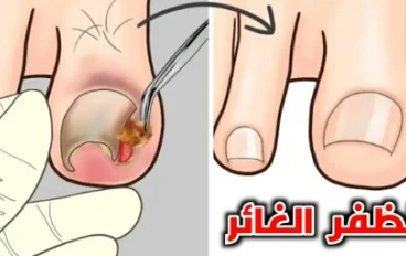 من القص الخاطئ الي العدوى الخطيره