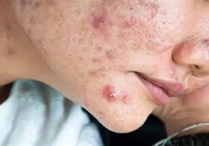 Acne: Causes, Symptoms, Treatment, and Prevention.
