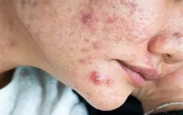 Acne: Causes, Symptoms, Treatment, and Prevention.